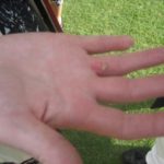 Mrs Phelps' blister