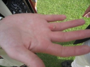 Mrs Phelps' blister