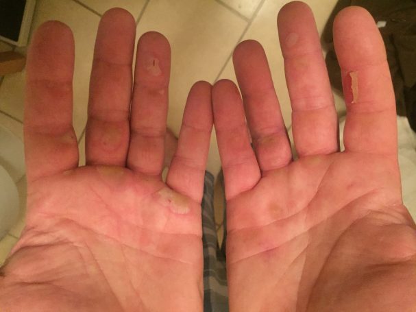 Rowing blistered hands