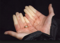 Reynauds Syndrome and rowers