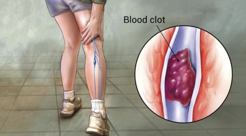 DVT in calf muscle. rowing blood clots